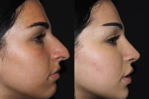 septoplasty surgery in dubai