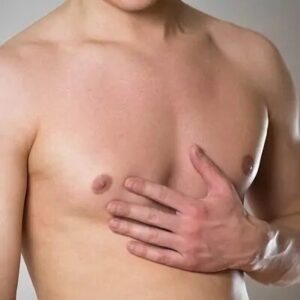 gynecomastia