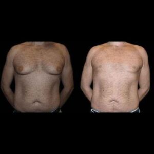 male breast surgery (2) (1) (1) (1) (1) (3)