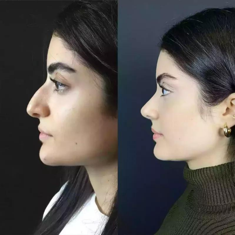 The Complete Guide to Rhinoplasty in Dubai: Procedures and Expectations