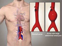 Endovascular Aneurysm Repair Market