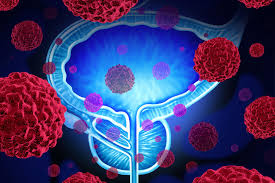 Prostate Cancer Diagnostics Market