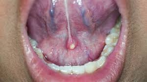 Salivary Gland Infection Market