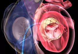 Transcatheter Heart Valve Replacement Market